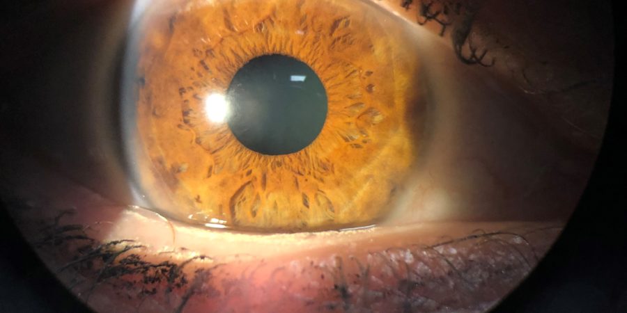 Seven Options in Correcting or Refractive Eye Procedures